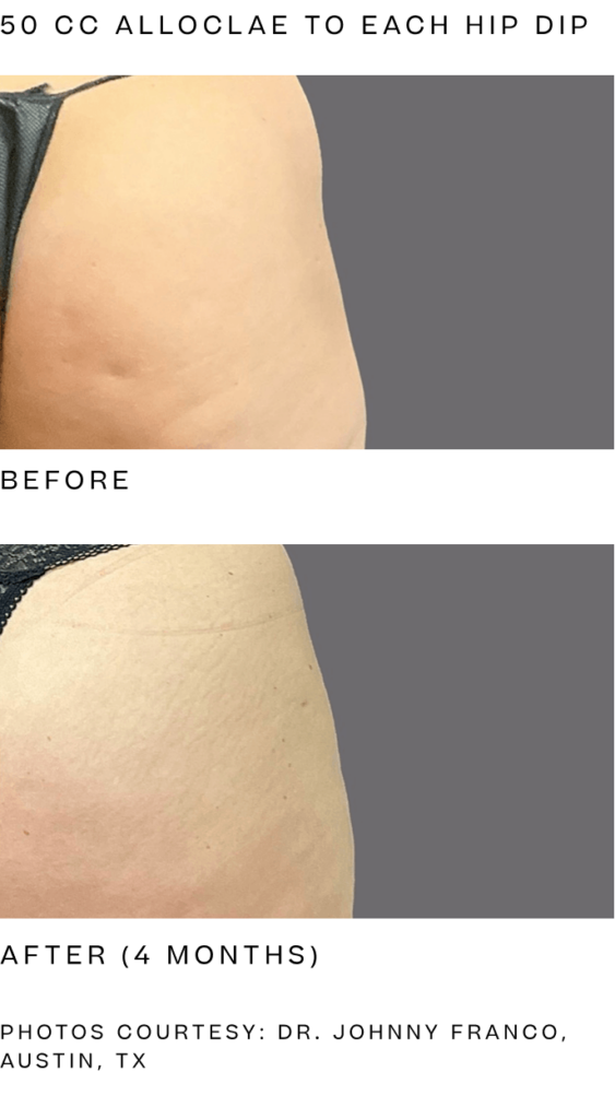 Alloclae Reviews | Hear from Real Patients & See Before and After Photos