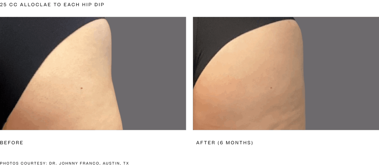 Alloclae Reviews | Hear from Real Patients & See Before and After Photos